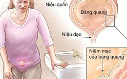 Viêm bàng quang tái lại nhiều lần