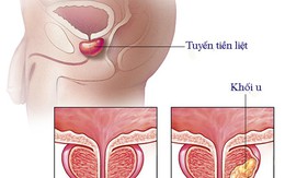 5 lầm tưởng thường gặp về ung thư tuyến tiền liệt