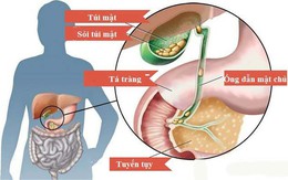 Cách phòng ngừa sỏi túi mật