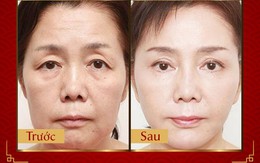 Phương pháp Laser Liposonic xóa nhăn, phục hồi da chảy xệ