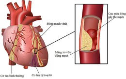 Rối loạn lipid máu và cách phòng ngừa