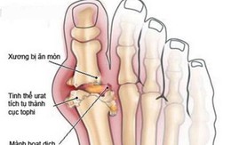 Có phòng ngừa tái phát bệnh gout được không?