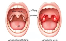 Phòng ngừa amidan “dở chứng”