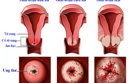 Dấu hiệu ung thư cổ tử cung