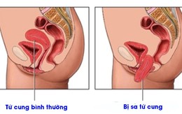 Vài điều cần biết về sa sinh dục