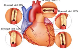 Hiểu biết về bệnh động mạch vành