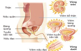 Dấu hiệu của viêm đường tiết niệu