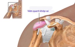 Viêm quanh khớp vai thể đông đặc