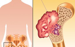 Phòng bệnh ung thư xương