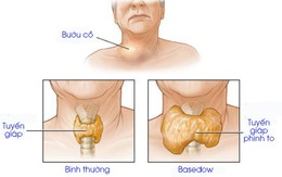 Những điều cần biết dành cho bệnh nhân Basedow