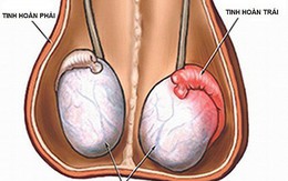 Hạn chế biến chứng viêm tinh hoàn