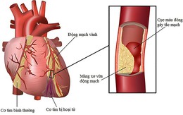 Yếu tố gây nên bệnh lý nhồi máu cơ tim hay bệnh vành tim