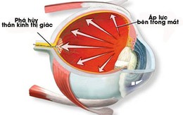 Không chủ quan với bệnh thiên đầu thống