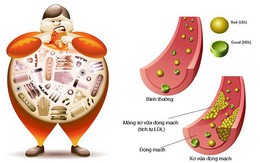 Tác hại do tăng mỡ máu và cách kiểm soát