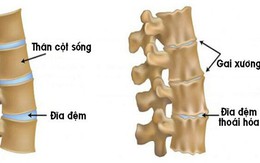 Chữa gai cột sống, vôi hóa cột sống