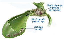 Bệnh sỏi mật