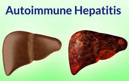 Viêm gan tự miễn trẻ em