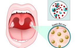 Căn bệnh của những nụ hôn