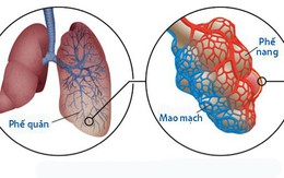Xơ hóa phổi vô căn