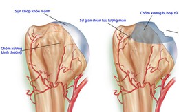 Hoại tử chỏm xương đùi do lạm dụng rượu bia, thuốc lá