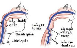 Mềm sụn thanh quản