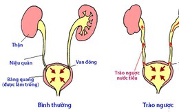 Bệnh trào ngược bàng quang - niệu quản ở trẻ em