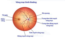 Bệnh đái tháo đường ảnh hưởng lên mắt như thế nào?