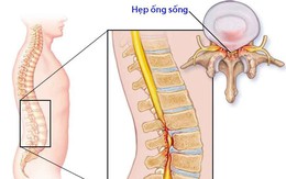 Hẹp ống sống thắt lưng