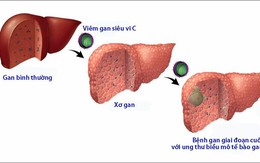 Thắc mắc thường gặp về viêm gan siêu vi C