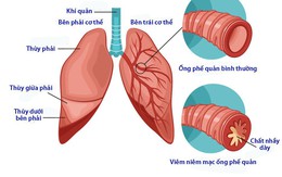 Phân biệt viêm phế quản do virus và viêm phế quản do vi khuẩn