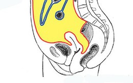 Viêm phúc mạc: Nguyên nhân, điều trị và phòng ngừa