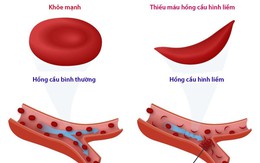 Bệnh thiếu máu hồng cầu hình liềm ở trẻ nhỏ