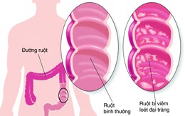 Bào tử lợi khuẩn LiveSpo COLON hỗ trợ điều trị viêm đại tràng