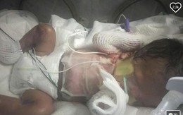 Bác sĩ Mỹ chữa trị cho bé sơ sinh không có da