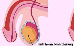 Tràn dịch tinh mạc ở trẻ em