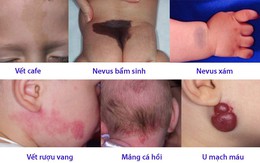 Điểm mặt các loại bớt ở trẻ em