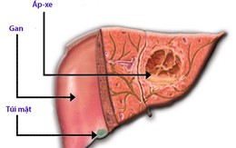 Áp-xe gan nguyên nhân và phương pháp điều trị