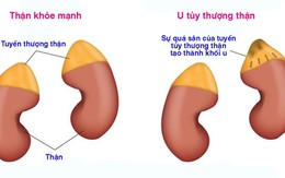 U tủy thượng thận