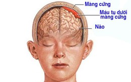 Máu tụ dưới màng cứng