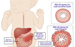 Viêm ruột hoại tử ở trẻ sơ sinh