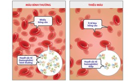 Bệnh thiếu máu do thiếu sắt ở trẻ sơ sinh