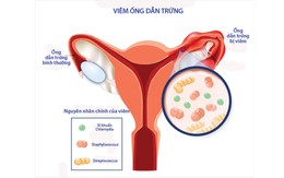 Các biến chứng thường gặp của viêm ống dẫn trứng