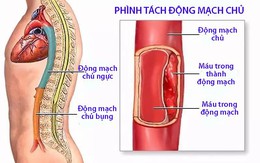 Bệnh phình tách thành động mạch chủ