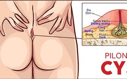 Bệnh nang lông dưới da vùng xương cùng cụt - xoang lông