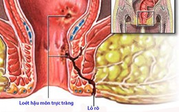 Bệnh Crohn quanh hậu môn