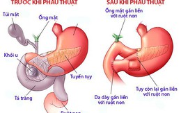 Những điều cần biết về Glucagonoma