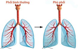 Phù phổi