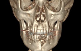 Vỡ hàm, mất răng vì thuốc lá điện tử nổ