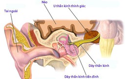 U tế bào thần kinh thính giác