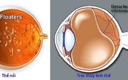 Thể nổi và chớp sáng